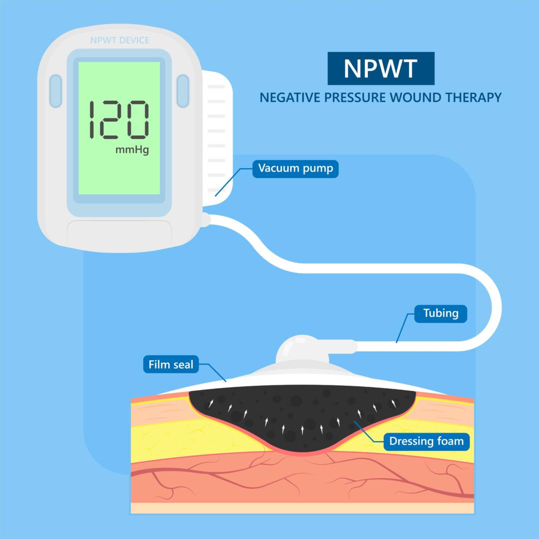 Negative Pressure Wound Therapy (NPWT) Device
